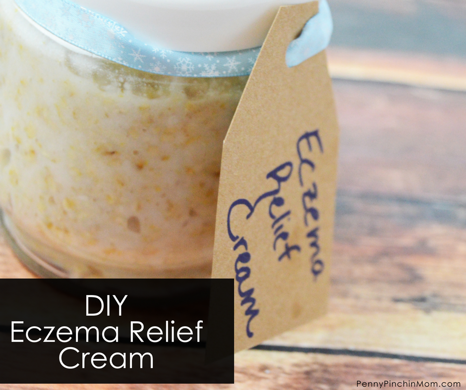 DIY Eczema Relief Cream Wipe out eczema in a hurry!